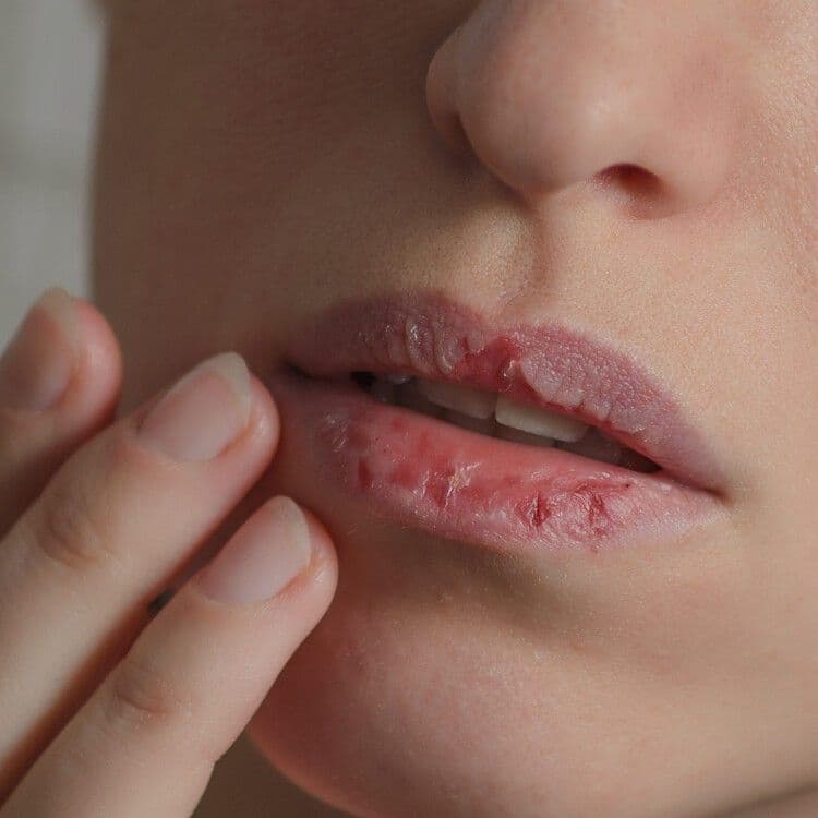 Dry Lips During Winter: Why It Happens & How Honey Can Help